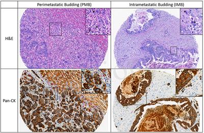 Evaluation of Tumor Budding in Primary Colorectal Cancer and Corresponding Liver Metastases Based on H&E and Pancytokeratin Staining